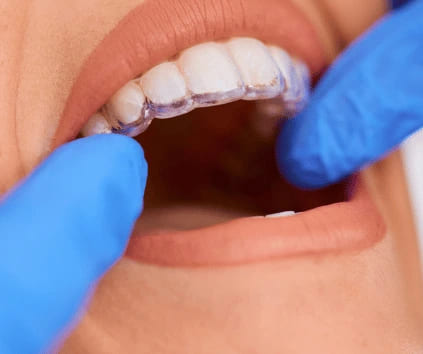 Invisalign treatment